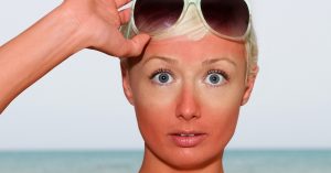 عوارض احتمالی آفتاب سوختگی بر روی پوست