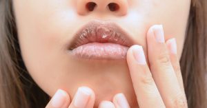 چند روش طبیعی برای درمان ترک گوشه دهان