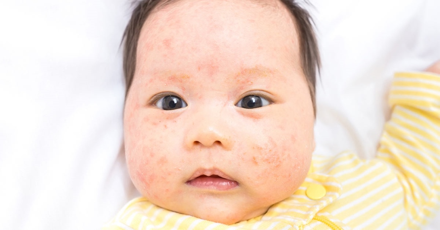 آشنایی با مهمترین مشکلات پوستی رایج در کودکان و نوزادان