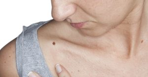 5 گروه از افرادی که در معرض خطر سرطان پوست هستند