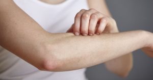 بثورات پوستی روی آرنج ؛ علل، نشانه ها و عوارض ناشی از آن