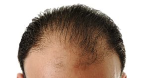 10 راه طبیعی برای جلوگیری از ریزش مو