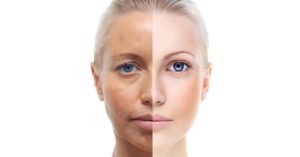 روش های خانگی برای درمان لکه های پوستی ناشی از افزایش سن