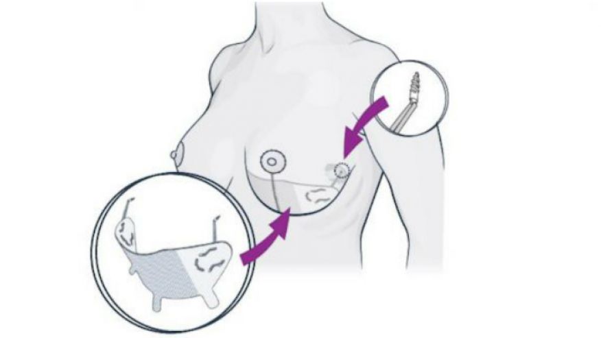 روش‌های لیفتینگ سینه بدون جراحی