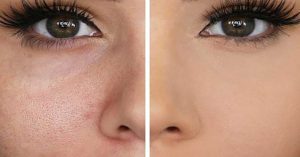 مراقب به منافذ پوستی ناشناخته در صورتتان باشید
