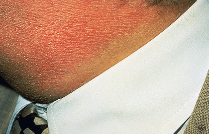 10 دلیل شایع برای قرمز شدن پوست صورت